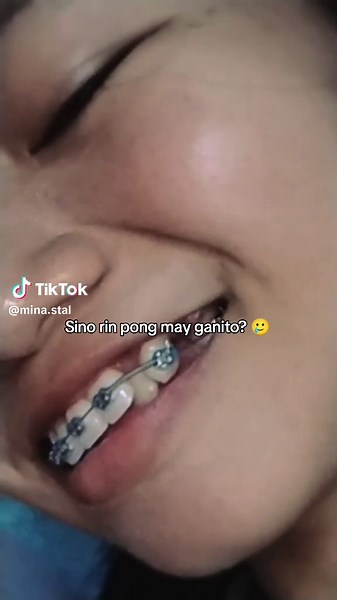 Understanding Open Coil Springs in Braces