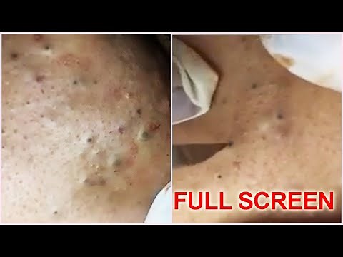 5 Years Old Blackheads Removal - Best Pimple Popping Videos