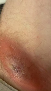 Infected lymph node swelled and popped a couple weeks ago. It has since been treated.