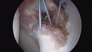 Hip Arthroscopy: Labral Base Repair with Knotless Anchors