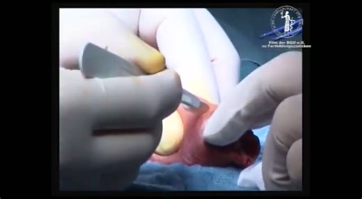 Corporoplasty