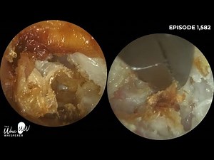1,582 - Ear Wax Removal, Dead Skin & Debris Extraction from Mastoidectomy Ear