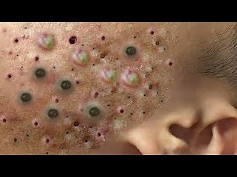 Blackheads & Milia, Big Cystic Acne Blackheads Extraction whiteheads Removal pimple Popping ##005