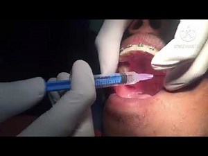 orthodontic extraction of maxillary left first premolar by Dr Asanul Banna | premolar extraction
