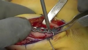 Proximal Phalanx Fracture Surgery