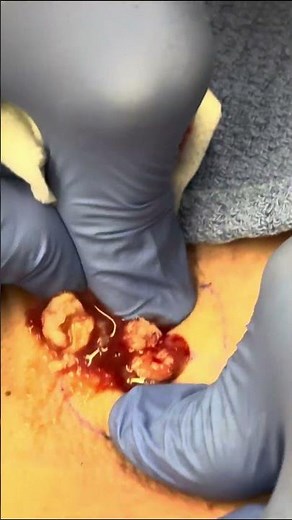Back Cyst Pop | Dr. Derm