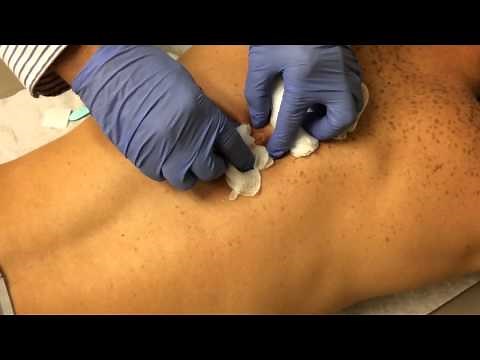 Kyle's Abscess Popping - GROSS