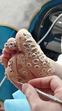 Pedicure#136/Peeling skin/foot wart/hardskin/FOOT CALLUS/FUNGAL NAIL/CORN TREATMENT/足底疣