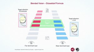 Patient Feedback on the Hydrophobic Acunex IOL - Eyetube