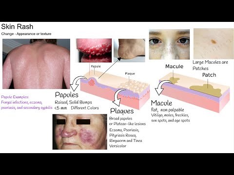 Understanding Rash in 3 minutes. Skin Rash types and causes.