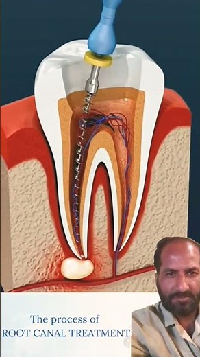 Root canal cleaning mathod go pain go dental care dental treatment