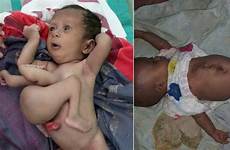 baby twin parasitic born limbs removed extra foxnews has twins parasite old before after liver her attached
