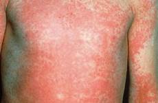 fever scarlet rash symptoms causes long contents