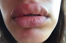 lips big always better injections juvederm biglips happen let don