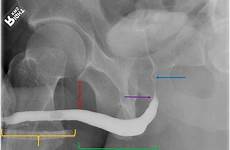 urethral urethra strictures urethrography fig anatomy radiologists retrograde clinical penile