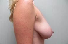 reduction breast tits