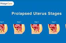 prolapse uterus pelvic organ prolapsed stages uterine vaginal