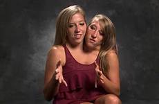 abby siamesische britt brittany hensel zwillinge twins conjoined abigail langweiledich shared