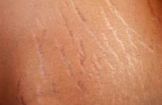 stretch marks happen causes