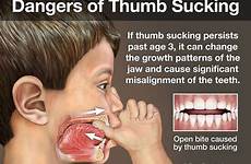 sucking thumb treatment early bad habits dangers correcting orthodontic