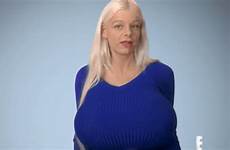 breast implants implant botched