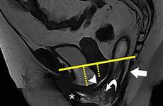 prolapse pelvic uterine rectal imaging ultrasound radiopaedia rg radiographics