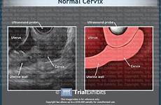 cervix ultrasound uterus uterine