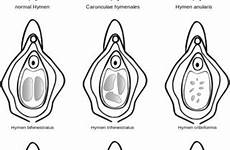 hymen tissue configurations assault dispelling myths determining
