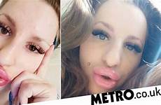 lips huge filler woman metro having
