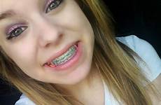 braces girls cute tumblr colors smile tweens smoking wet brace teeth hot xxx green face dental