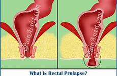 prolapse rectal anus anal pain protrusion symptoms male surgery causes pelvic exercise experience treatment inside just women hemorrhoids men exercises