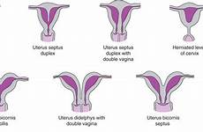 uterus anomalies gynecology urogenital horn diagnosis obstetrics treatment current congenital rudimentary embryology genital puberty