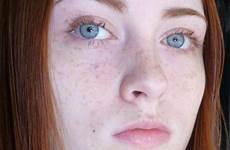 freckles pale freckle redheads