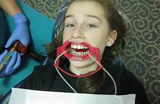 her waiting she mouth open braces wide entire said been held bottom shes life contraption