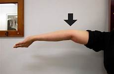 elbow elbows hypermobility jointed