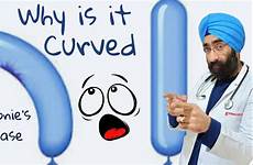 penis curved cure disease peyronie