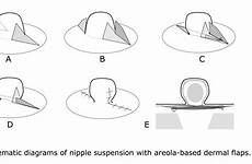 nipple inverted flaps correction synopsis dermal asps