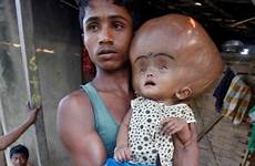 head baby roona begum girl giant indian skull india abnormal happened medical condition huge causes ibtimes hydrocephalus runa who reduction