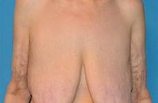 saggy breast reduction