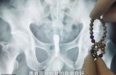 inserted stuck urethra inserts dreaming bladder bundled insertion bead insertions sensitive