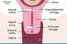 cervix cerclage uterus anatomie transabdominal tightening