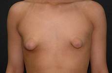 puffy areolas malformed