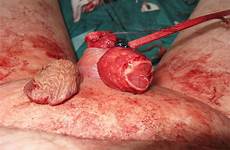 tumblr penectomy tumbex head off