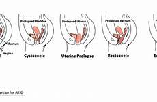 prolapse pelvic uterine organ dysfunction incontinence