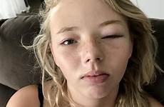 eye girl mask after teen reaction kmart left her open pain blind half