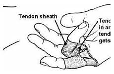 finger trigger hand patient right ring fingers causes diagram tenosynovitis after information bent little