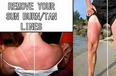 tan lines sun burn