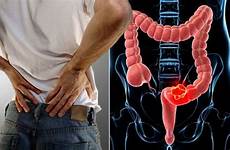pain back cancer bowel passage never sometimes ignore warning should colon rectal