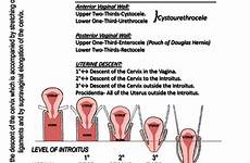prolapse uterus uterine prolapsed prolaps grading uteri pelvic exercises derajat ciri ultrasound recti lunak