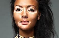 vitiligo mdedge